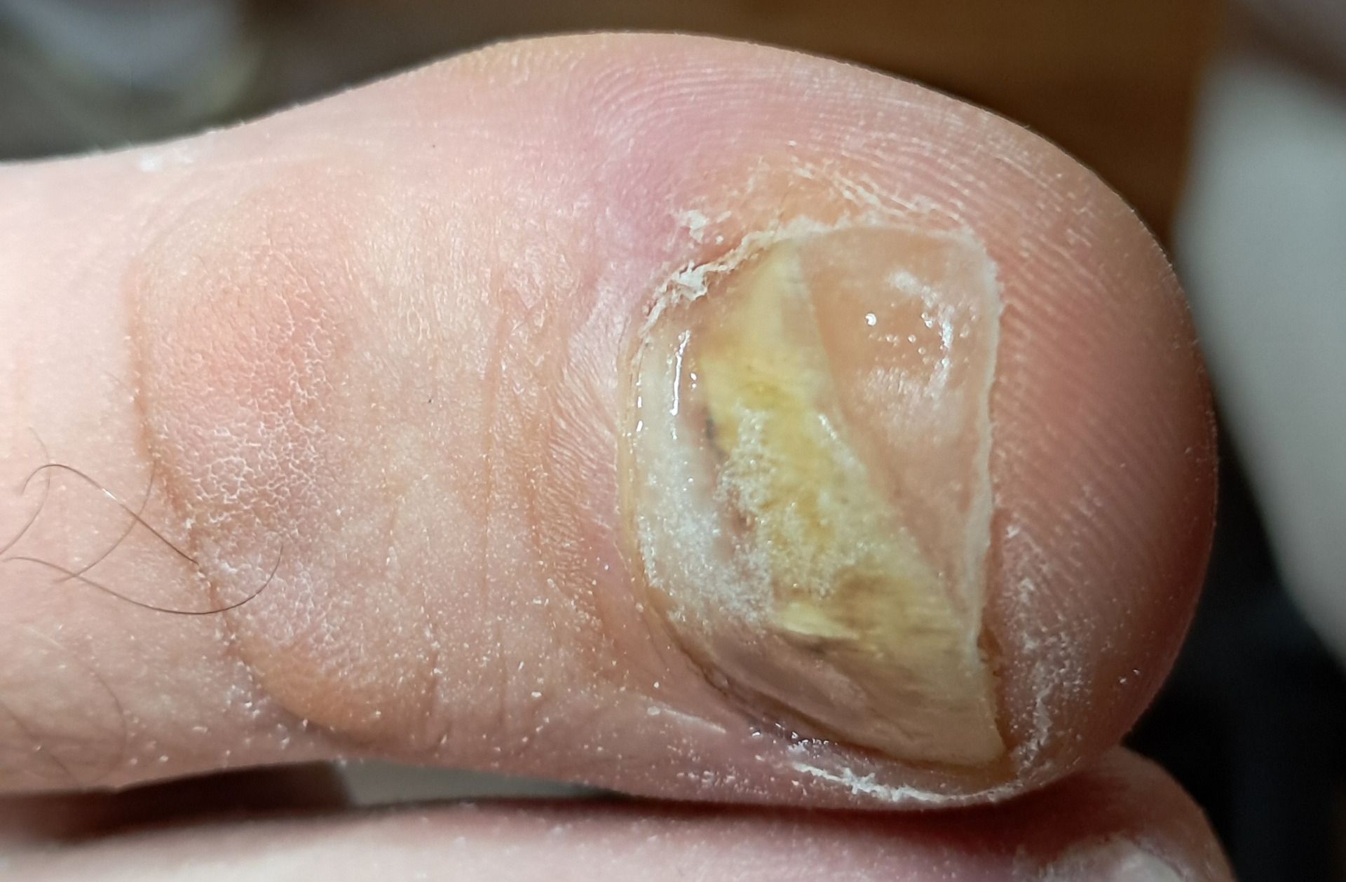 Nehtová náhrada po úpravě.