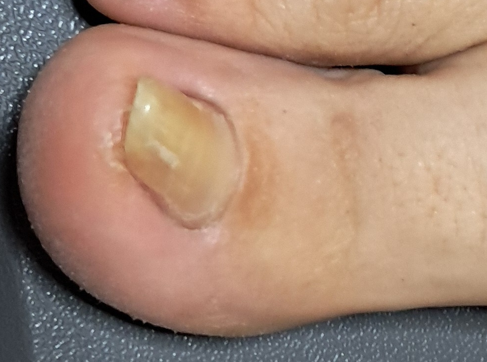 Levý nehet po úpravě.